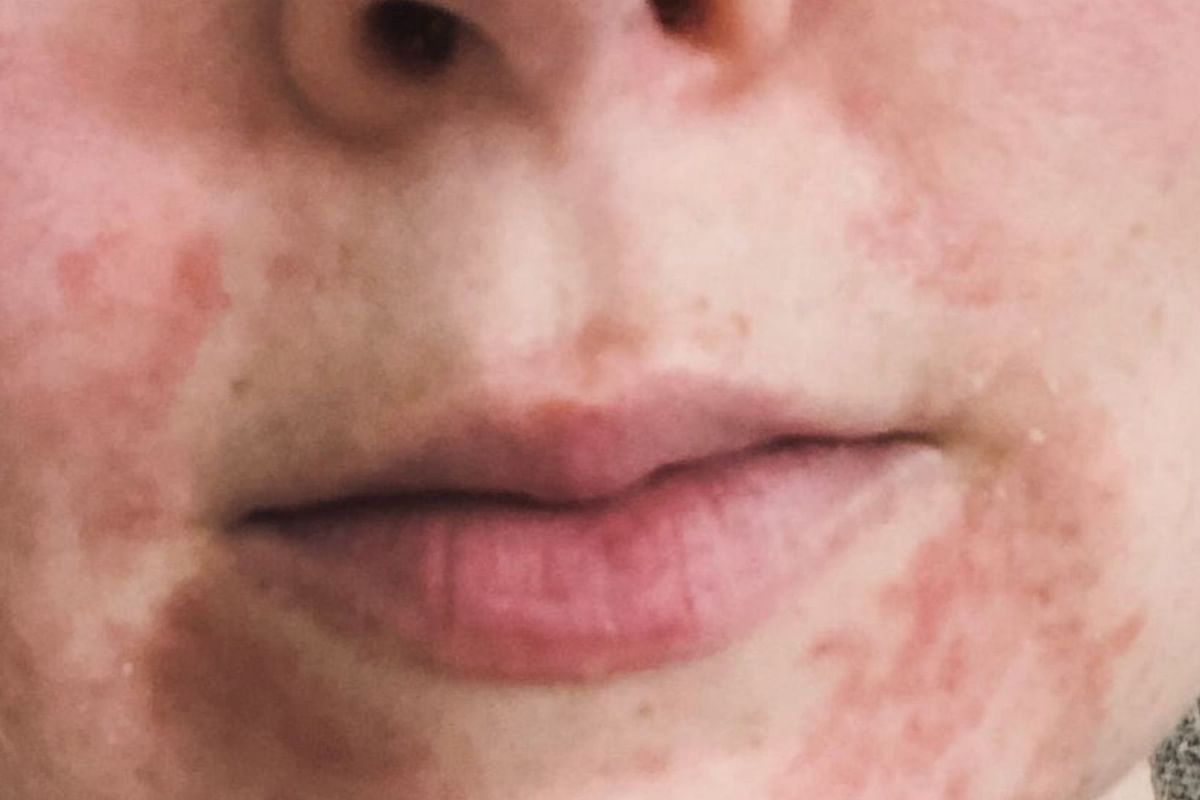 What Is Perioral Dermatitis All About Its Causes Treatments And Healing Stages 