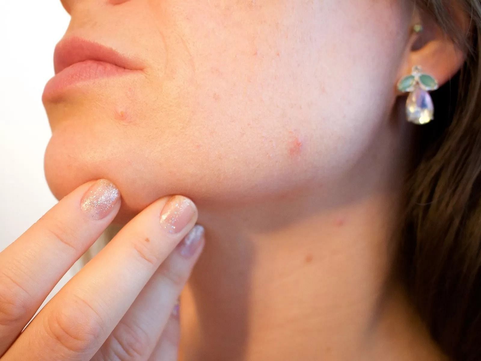 Toothpaste on pimple (Image via Getty Images)