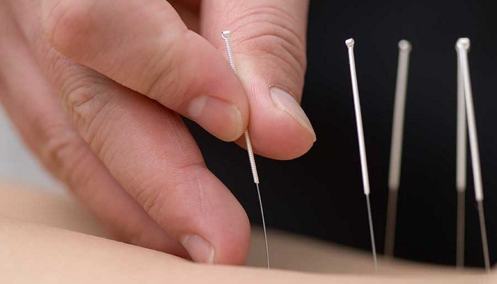 Acupuncturist performing the method on a patient (Image via Getty Images)