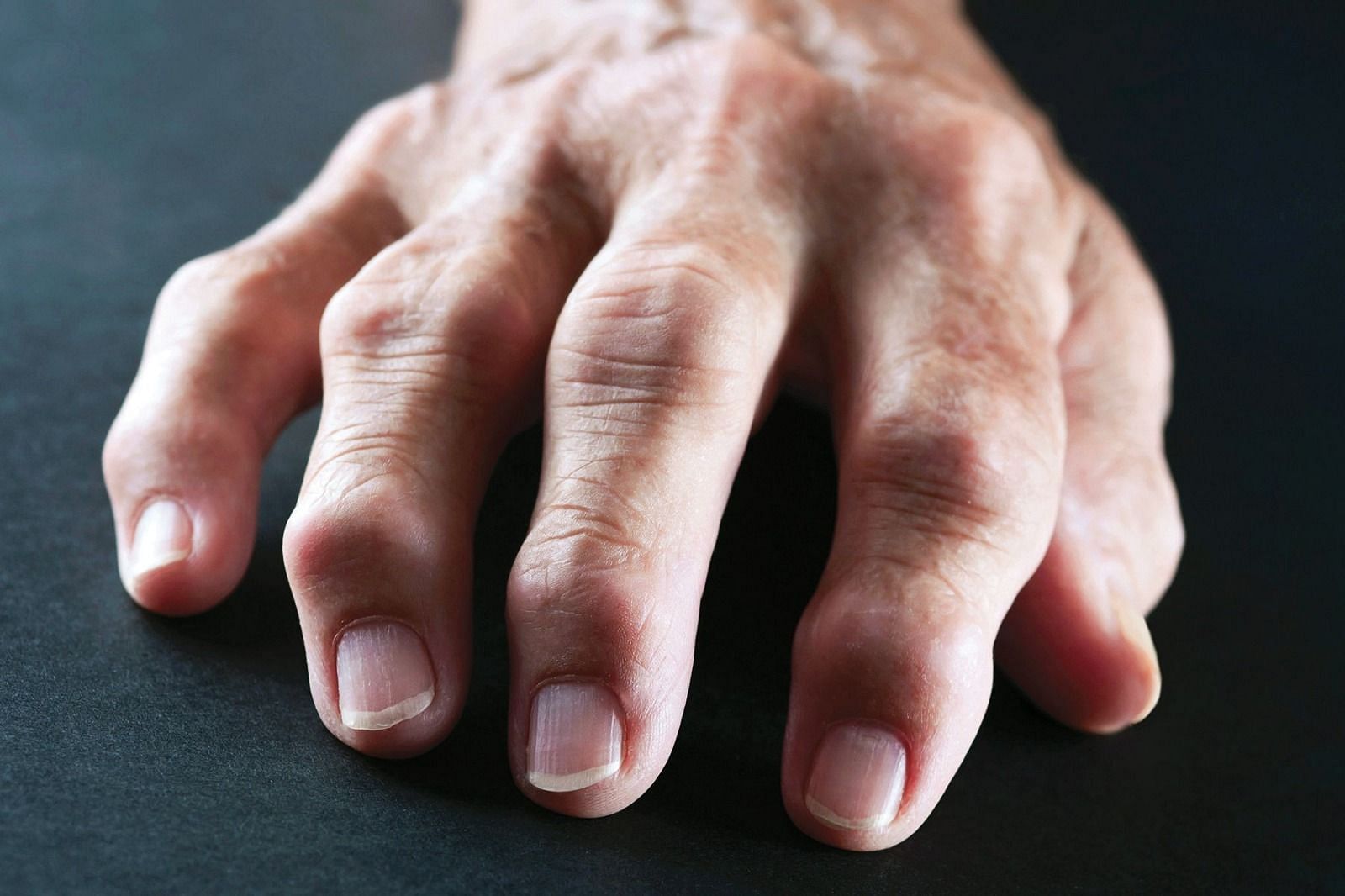 Arthritis in a human hand (Image via Getty Images)