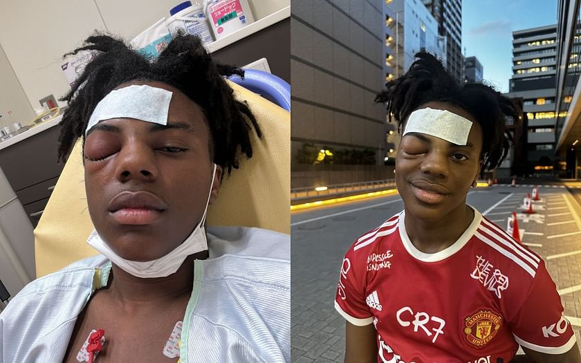 What Happened To iShowSpeed? Streamer's Eye Injury Led to Him Being in the Hospital — How He Is Now?