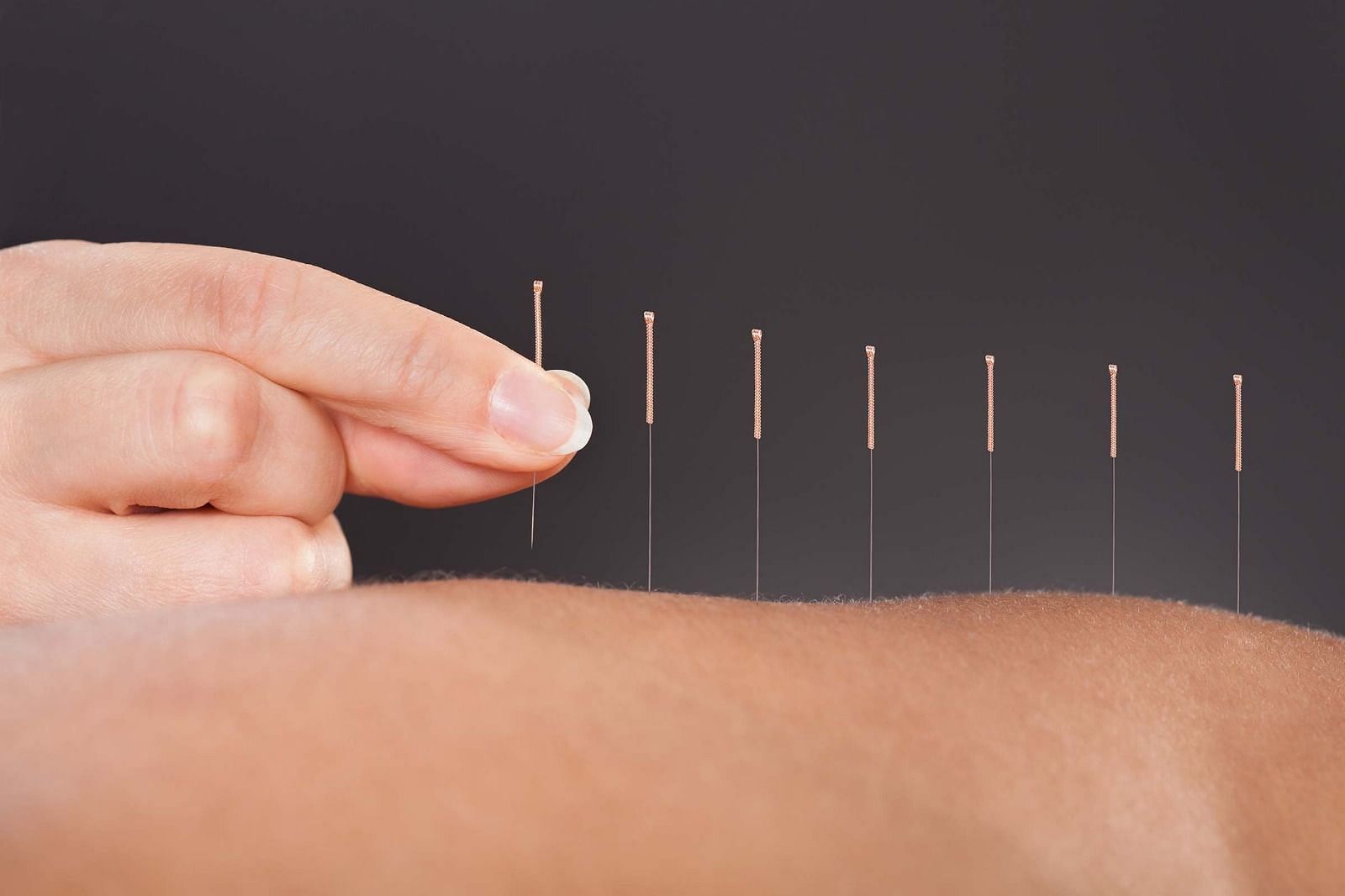 Acupuncture (Image via Getty Images)