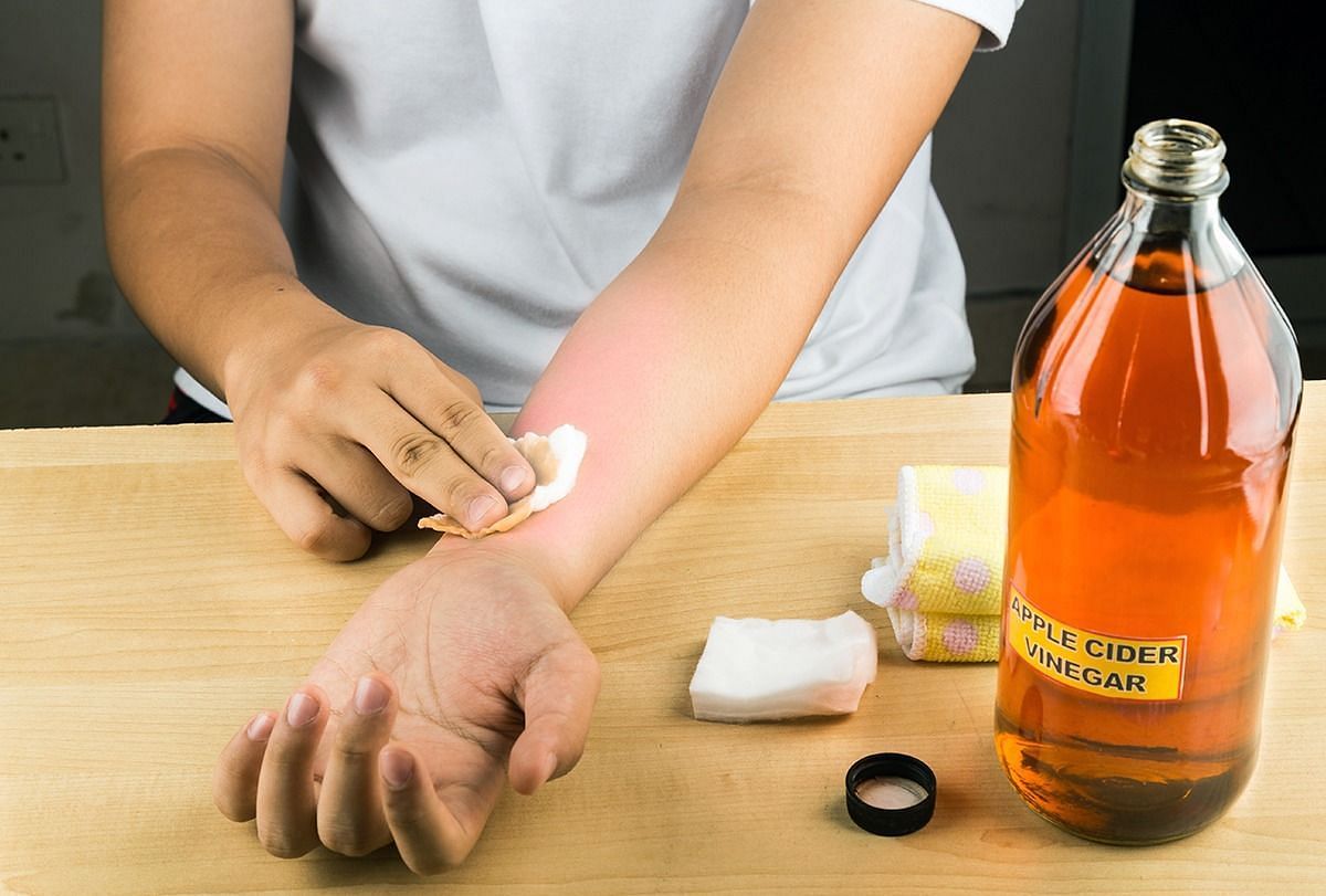 Applying apple-cider vinegar (Image via Getty images)