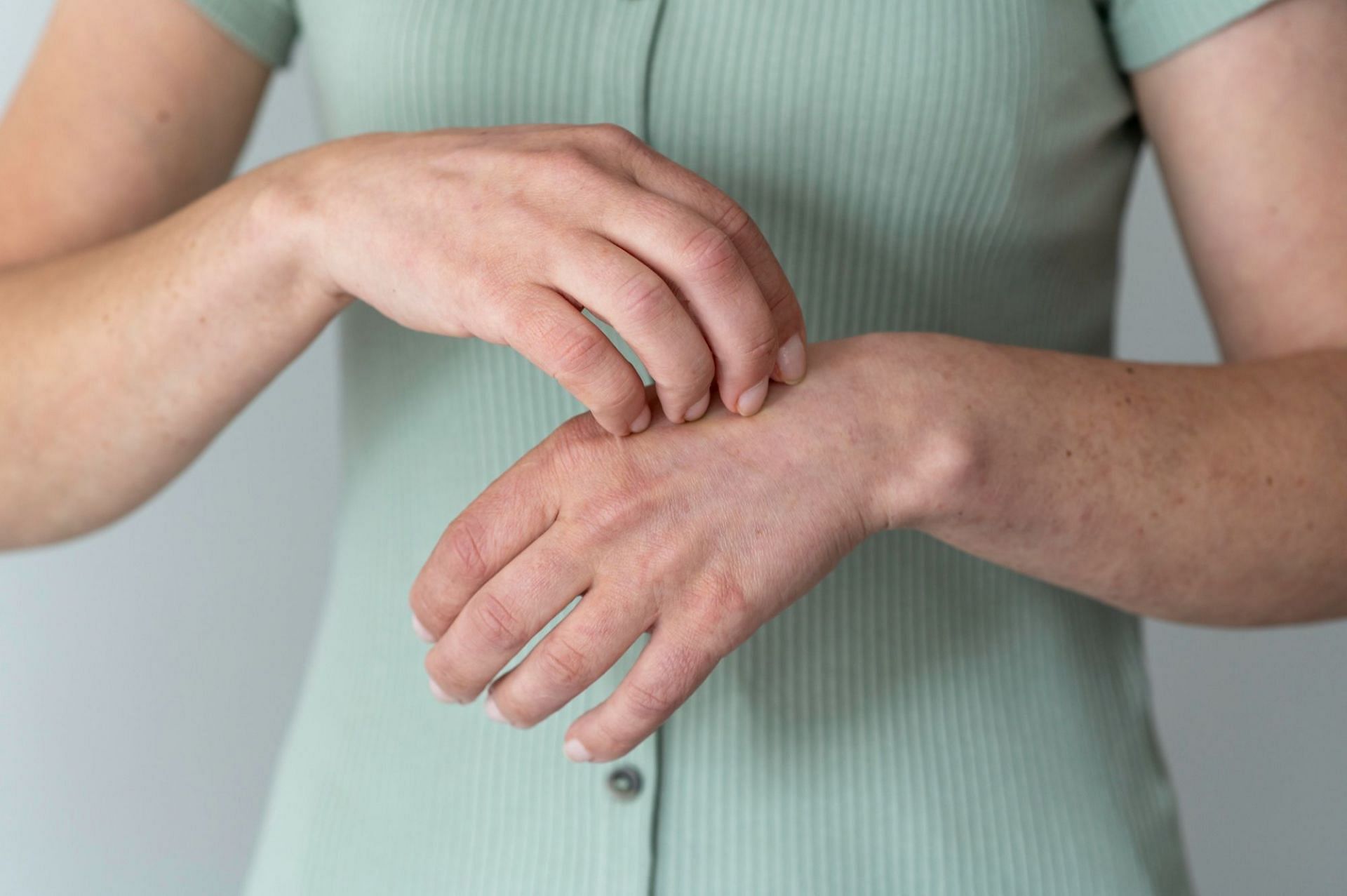 Stress Hives On Hands