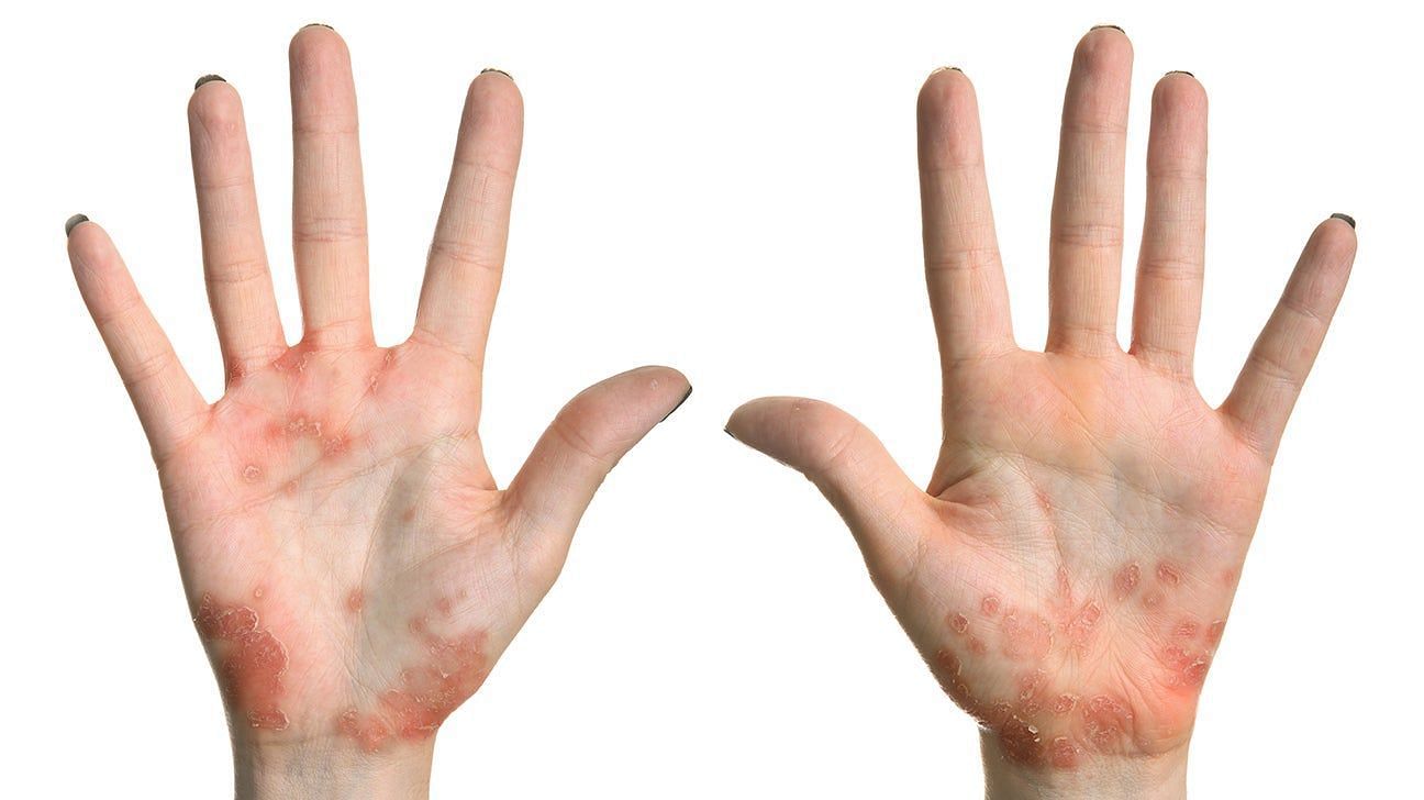 Psoriasis: Recognizing its Symptoms (Image via Medical News Today)