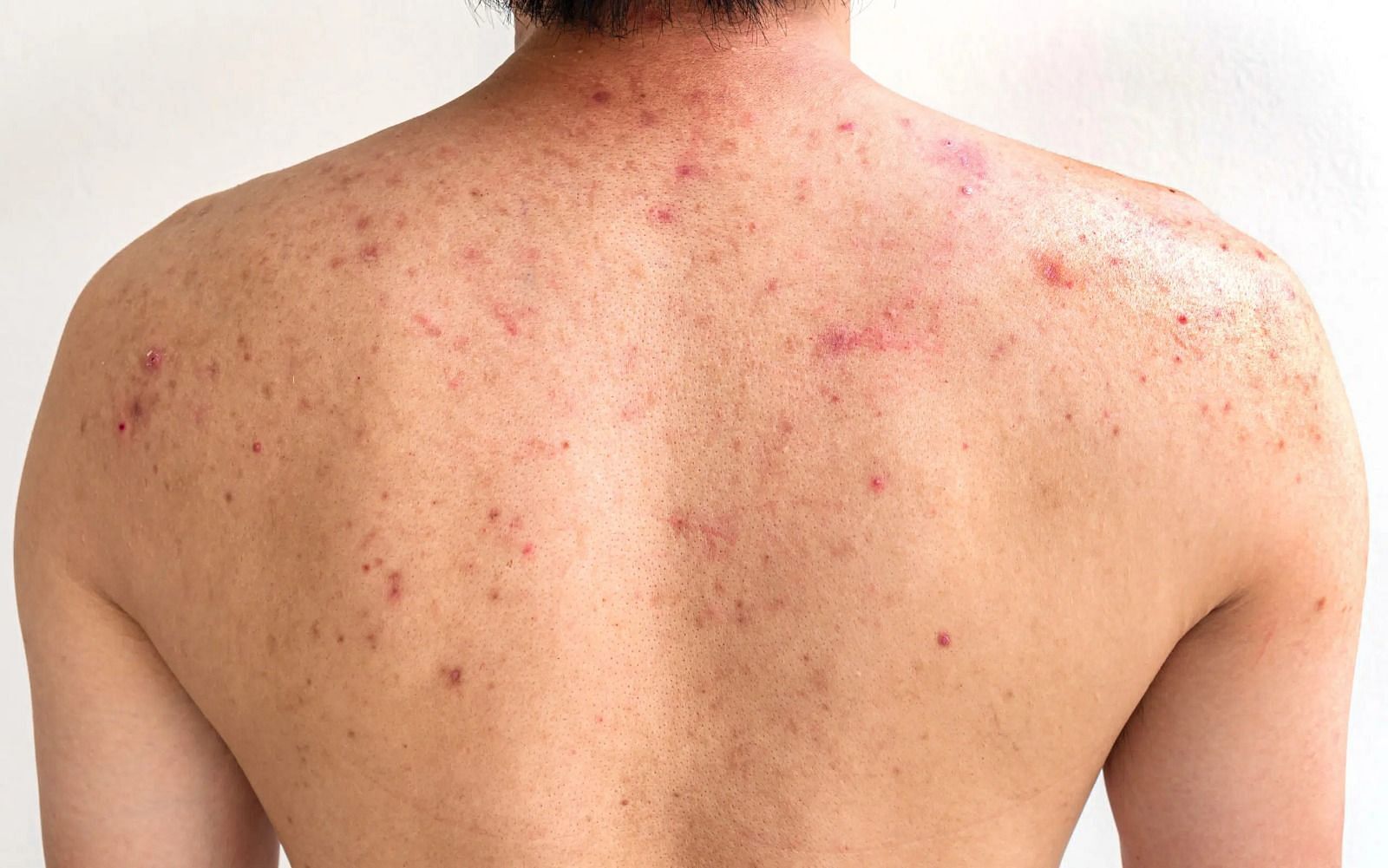 Acne on the back (Image via Getty Images)