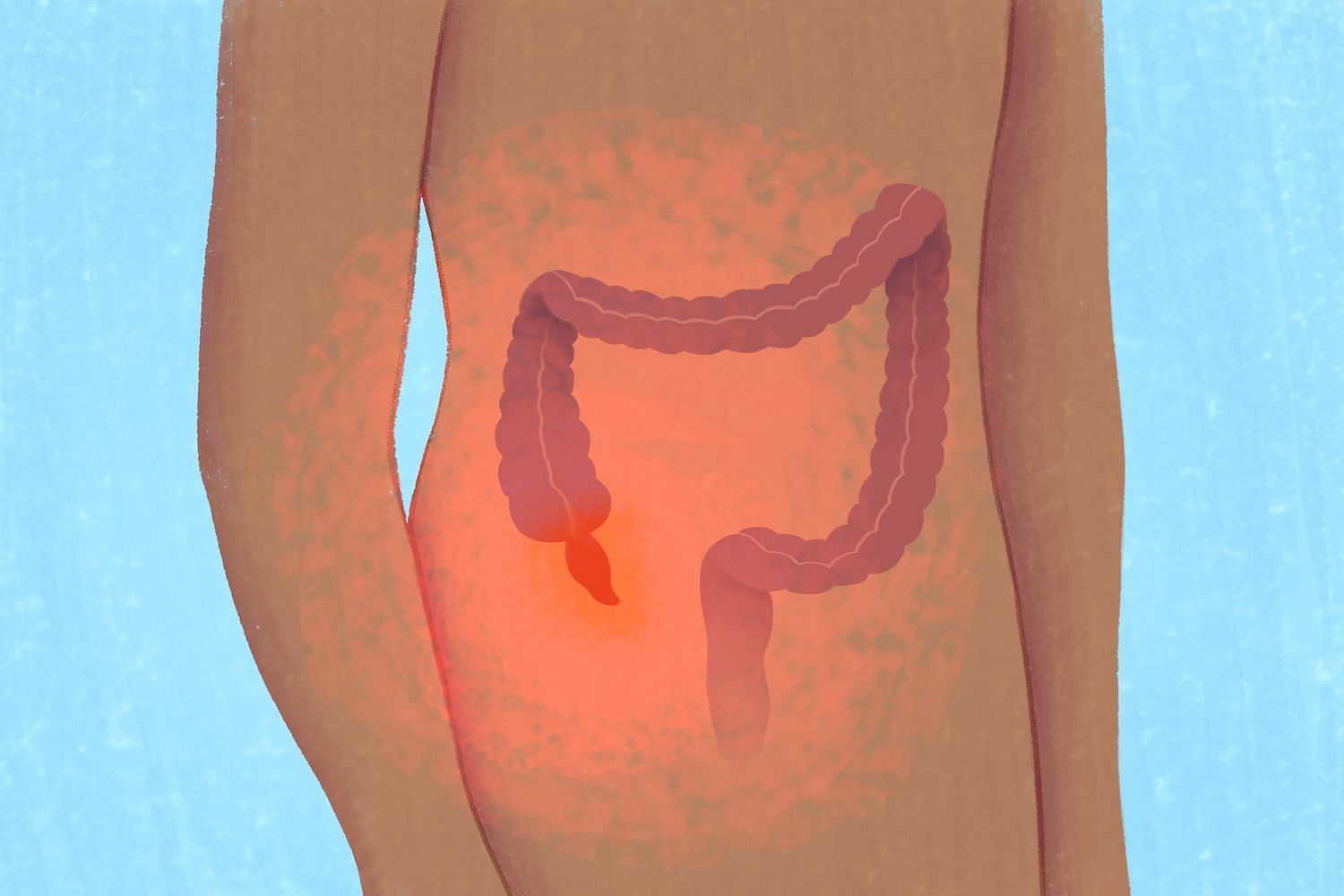 Swelling of the appendix (Image via Getty Images)