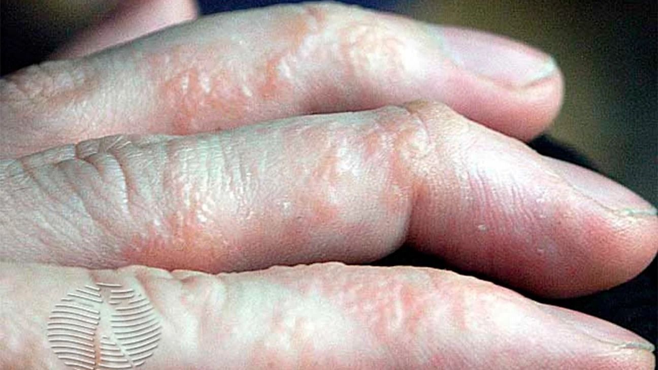 Dyshidrotic-eczema (Image via Getty Images)