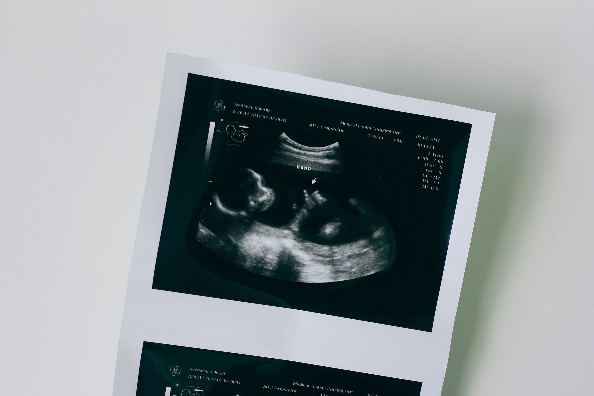 A sonogram picture of a human foetus. (Photo via Pexels/Valeriia Svietlova)