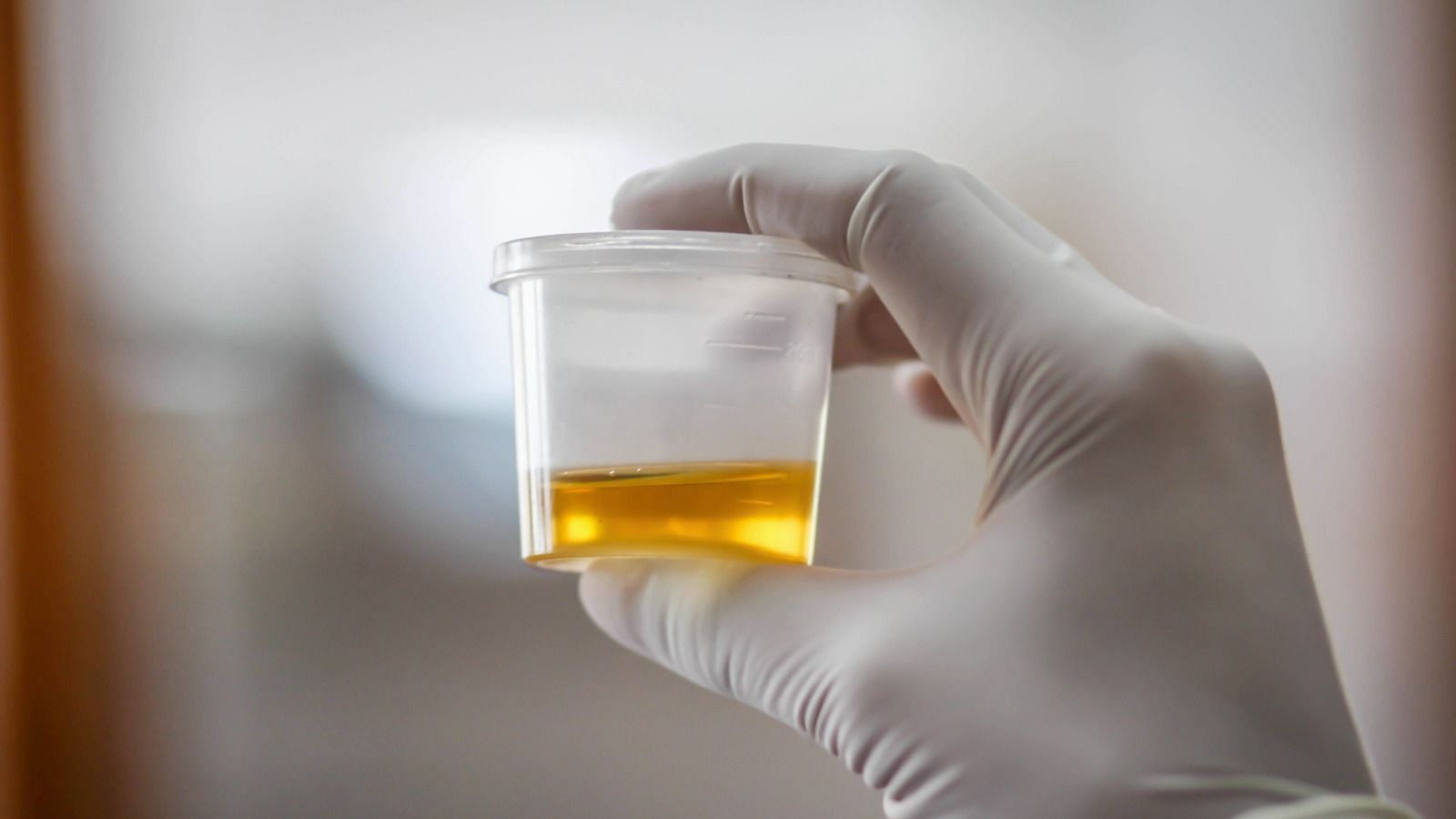 Protein in urine (Image via Getty Images)