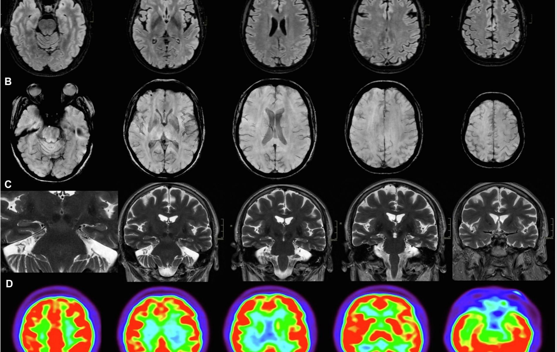 Brain fog symptoms include cognitive impairments such as memory loss (Image via Frontiers)