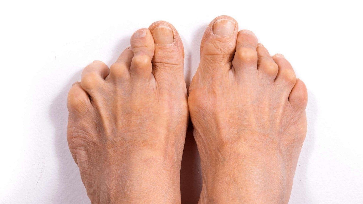 Arthritis in human feet (Image via Getty Images)