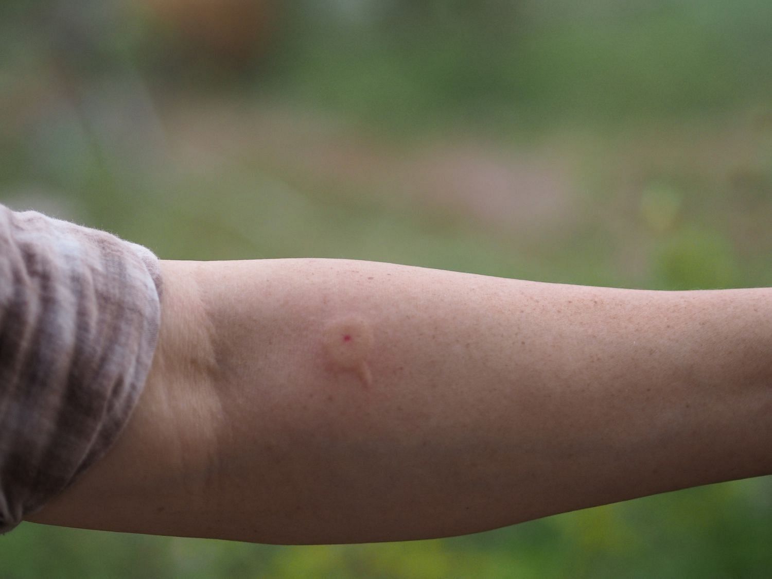 Wasp-sting (Image via Getty Images)