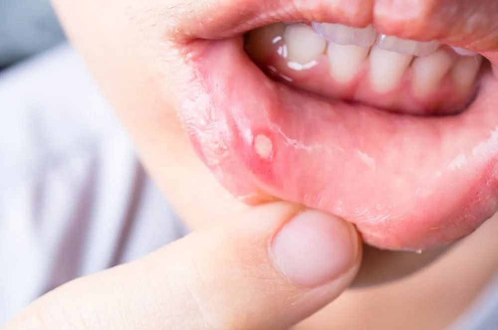 Canker-sores (Image via Getty Images)