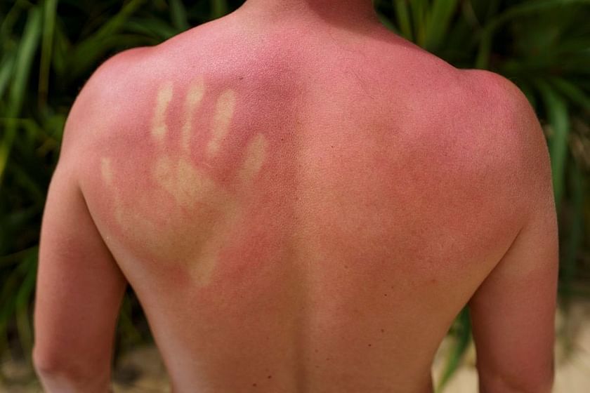 Sunburn: Symptoms & Treatment