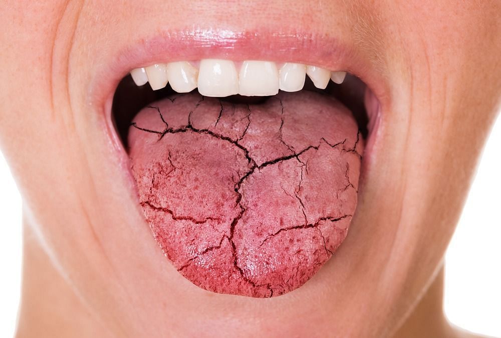 Dry mouth (Image via Getty Images)