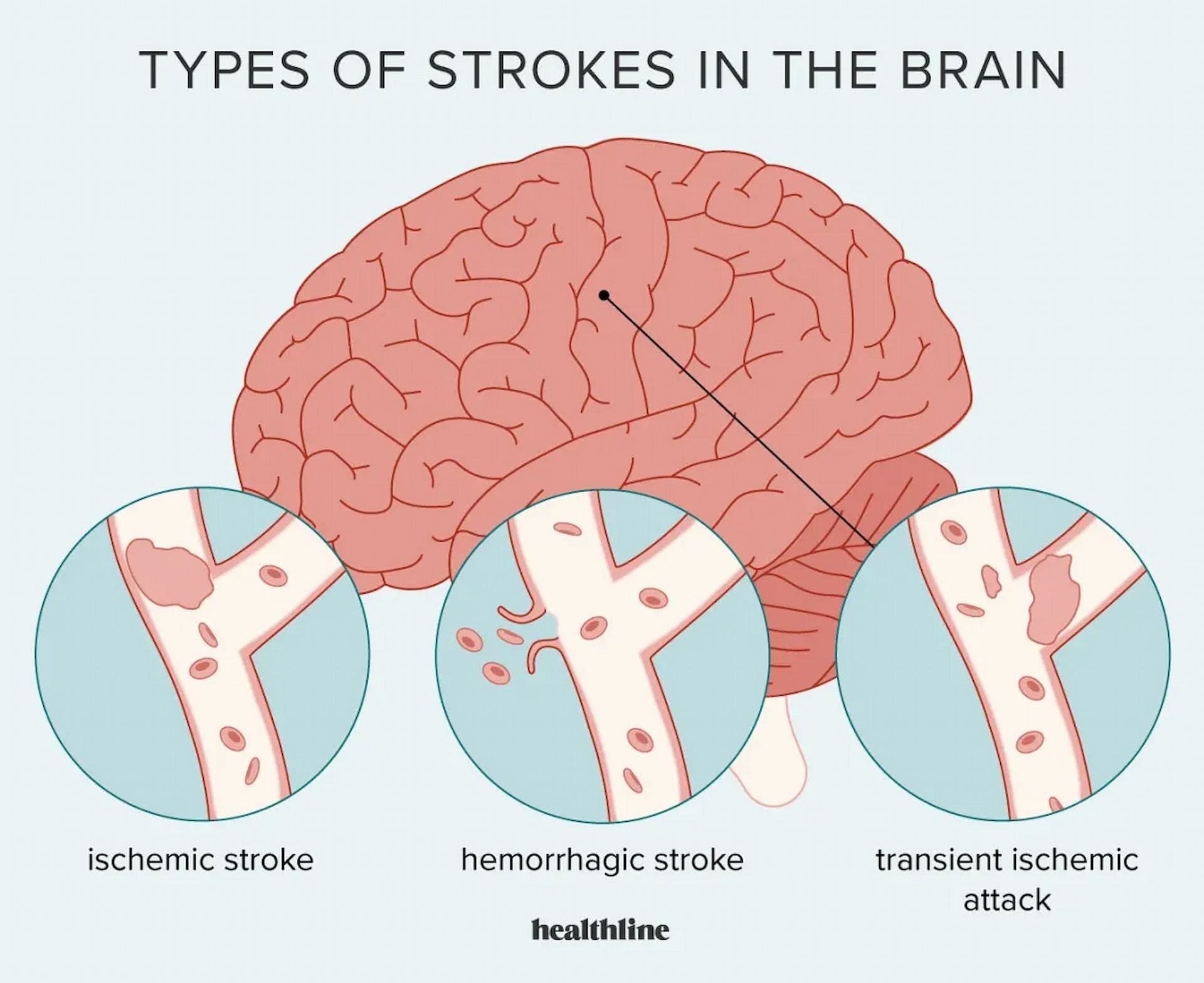 Types of stroke (Image via Healthline/Google)
