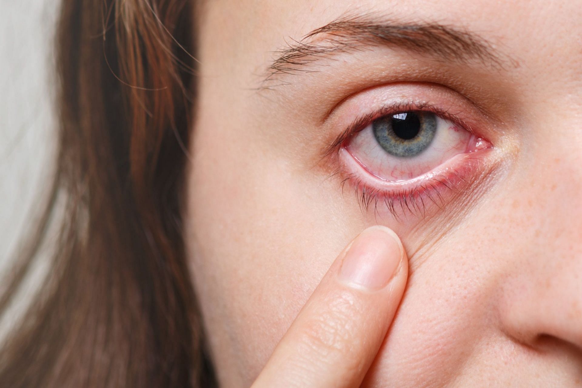 Symptoms of subconjunctival hemorrhage includes blood in eye. (Photo via Freepik)