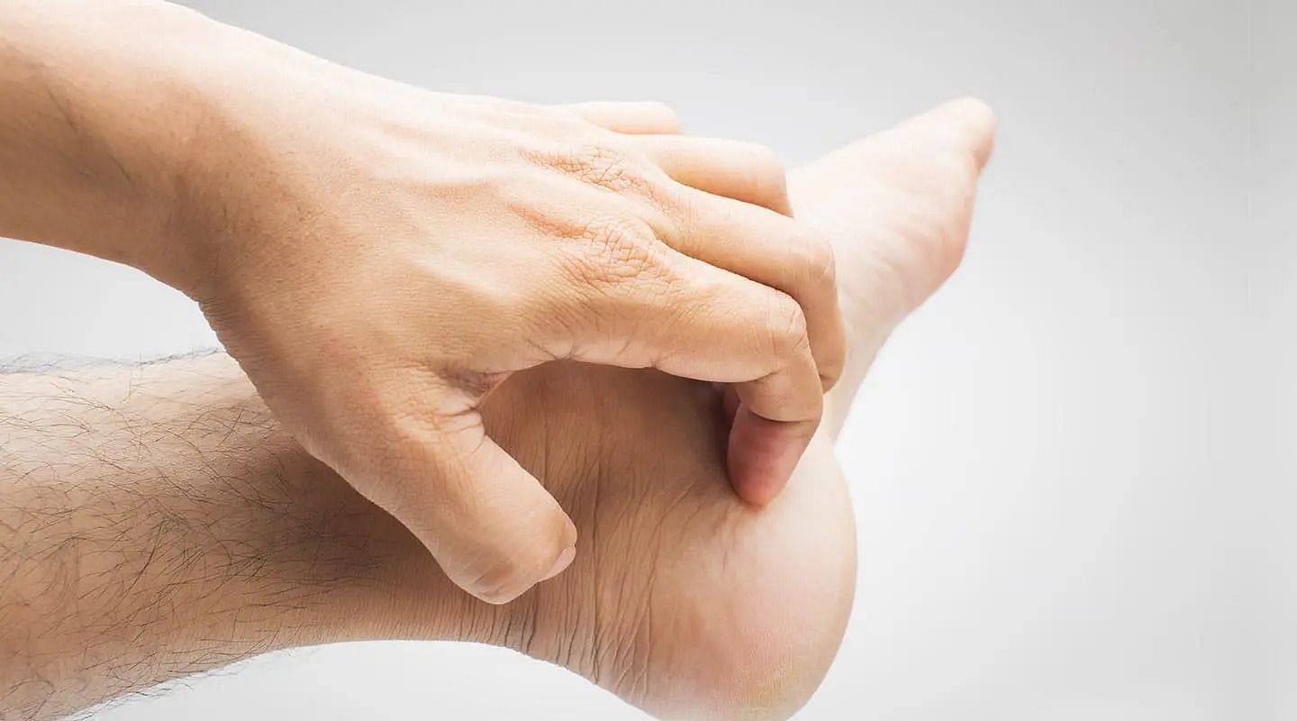 Dyshidrotic-eczema (Image via Getty Images)