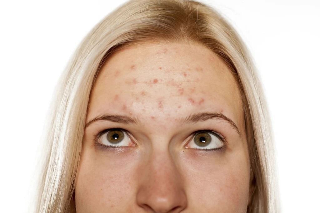 Acne on the forehead (Image via Getty Images)