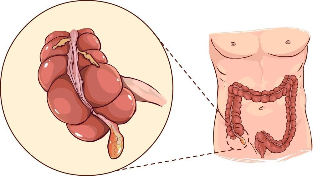 Appendicitis (Image via Getty Images)