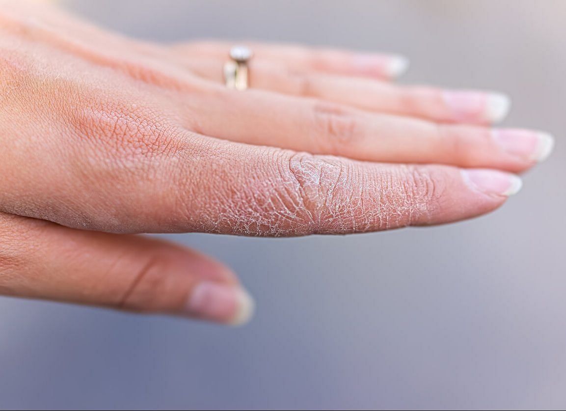 Dyshidrotic eczema (Image via Getty Images)