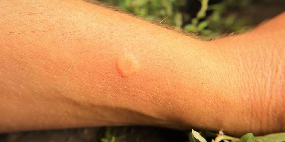 Wasp-sting (Image via Getty Images)