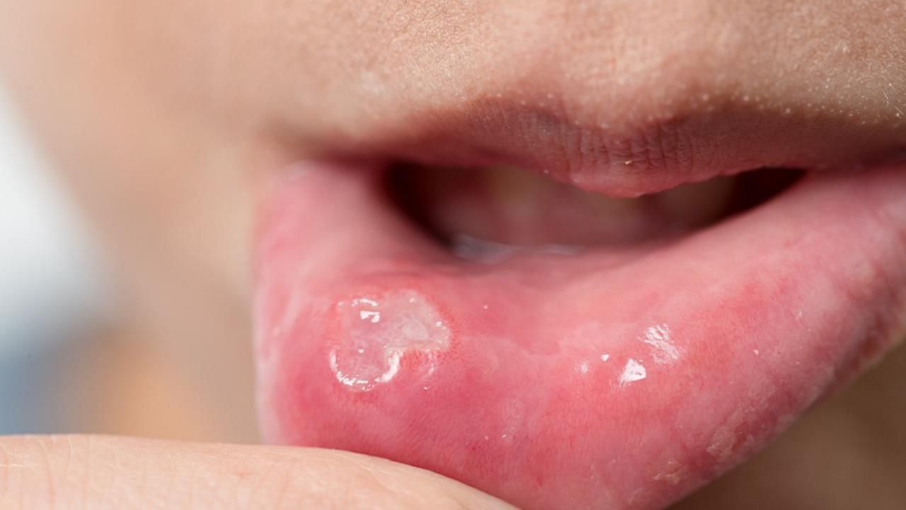 Canker-sores (Image via Getty Images)