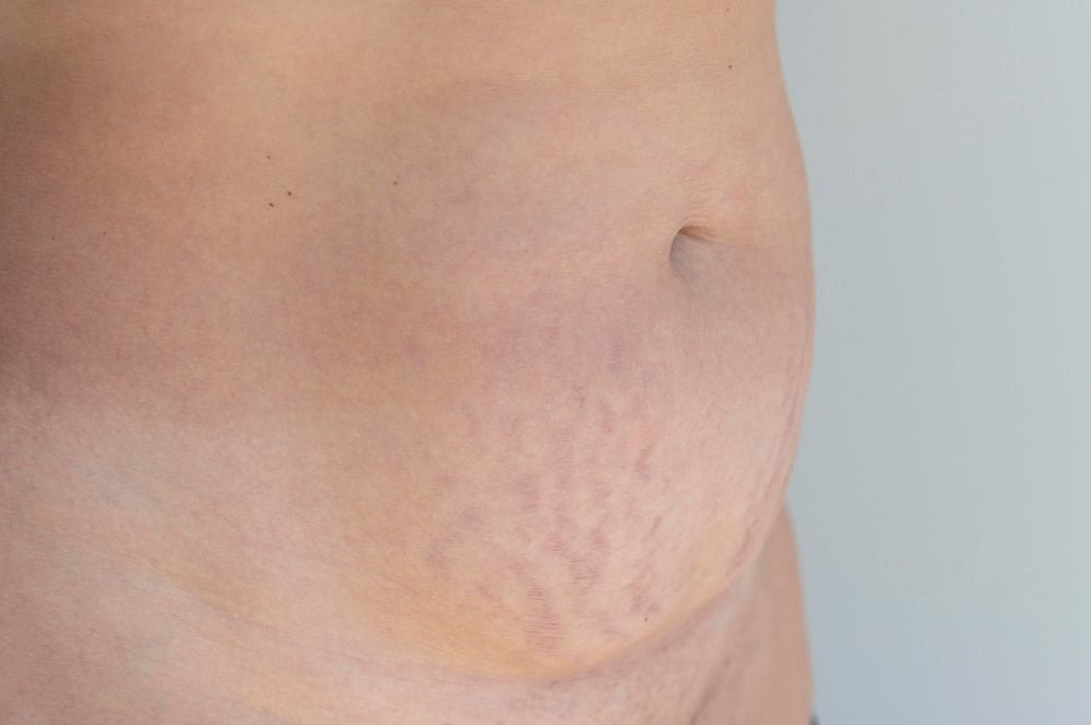 Belly marks (Image via Freepik)