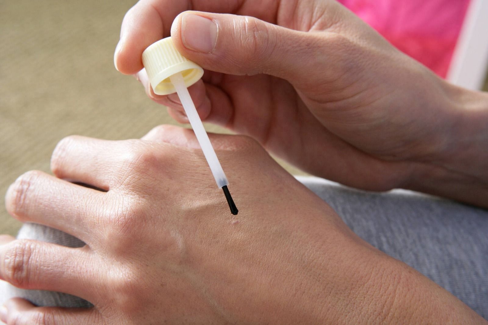 Applying apple-cider vinegar on the wart (Image via Getty)