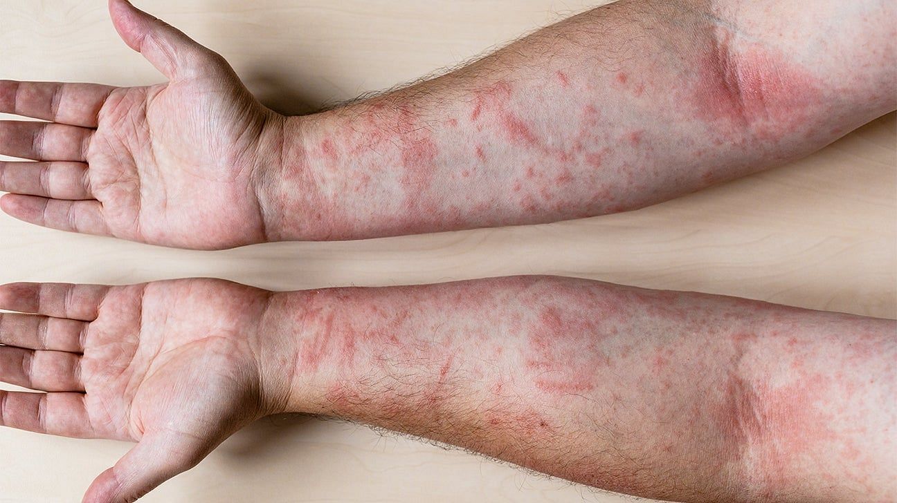 What Are The Symptoms Of Dermatitis? (Image via Healthline)