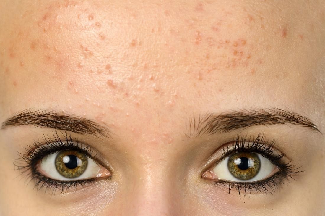 Forehead acne (Image via Getty Images)