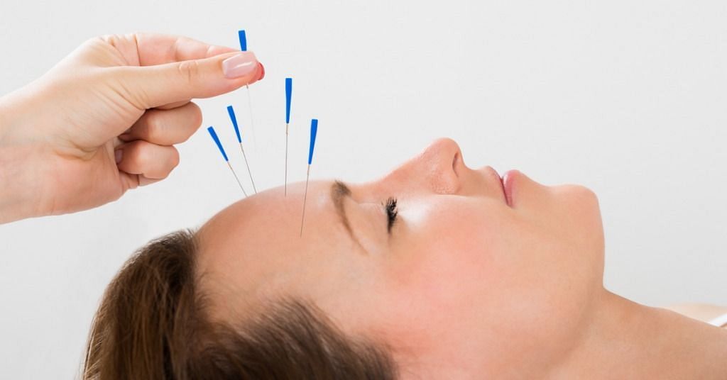 Acupuncturist performing the method on a patient (Image via Getty Images)