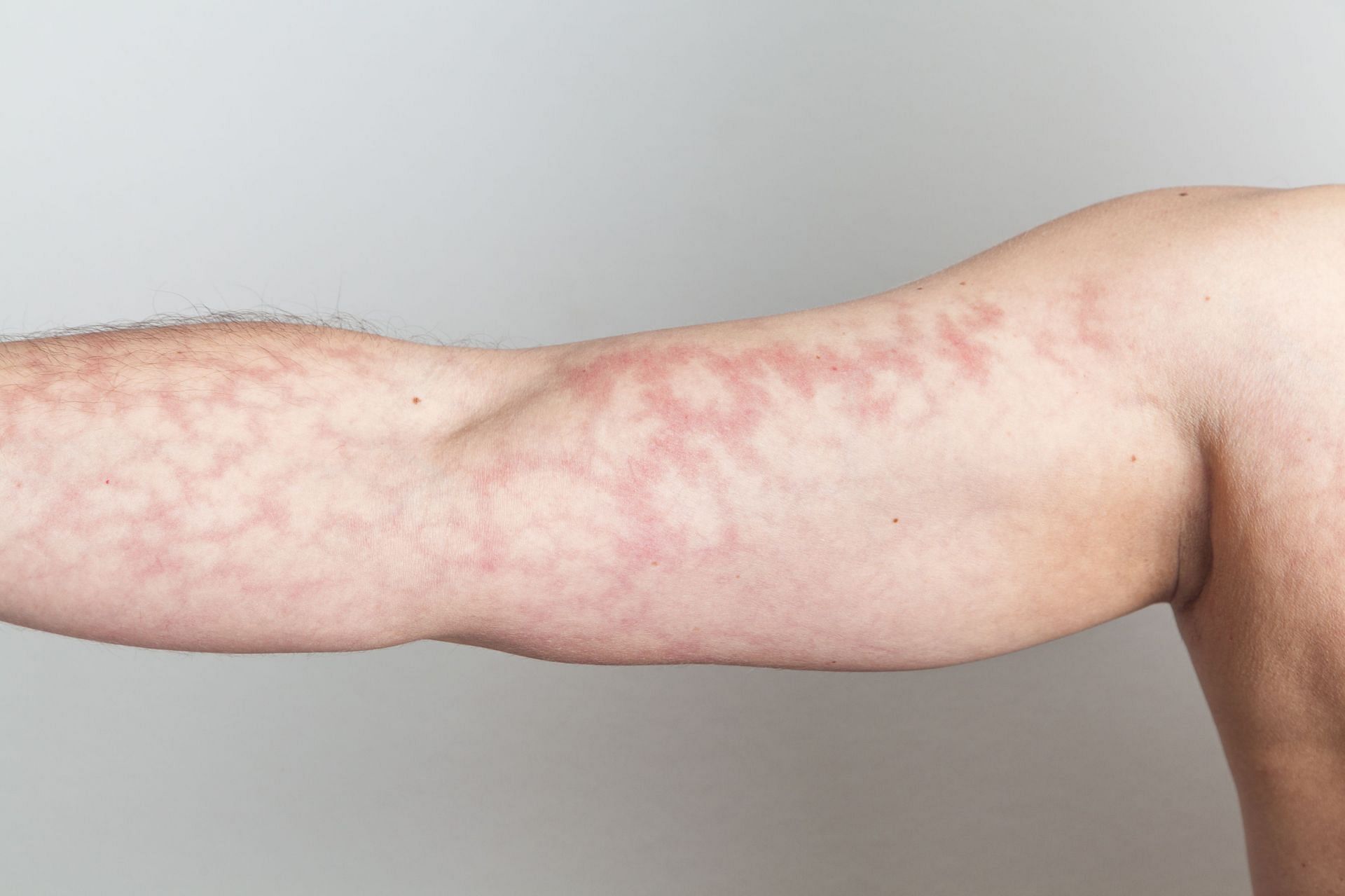 Mottled skin is a disorder that arises when blood flow to the skin is interrupted or restricted, and is characterized by net- or lace-like patterns on the skin