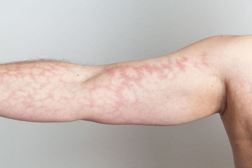 mottled-skin-the-underlying-causes-and-treatment