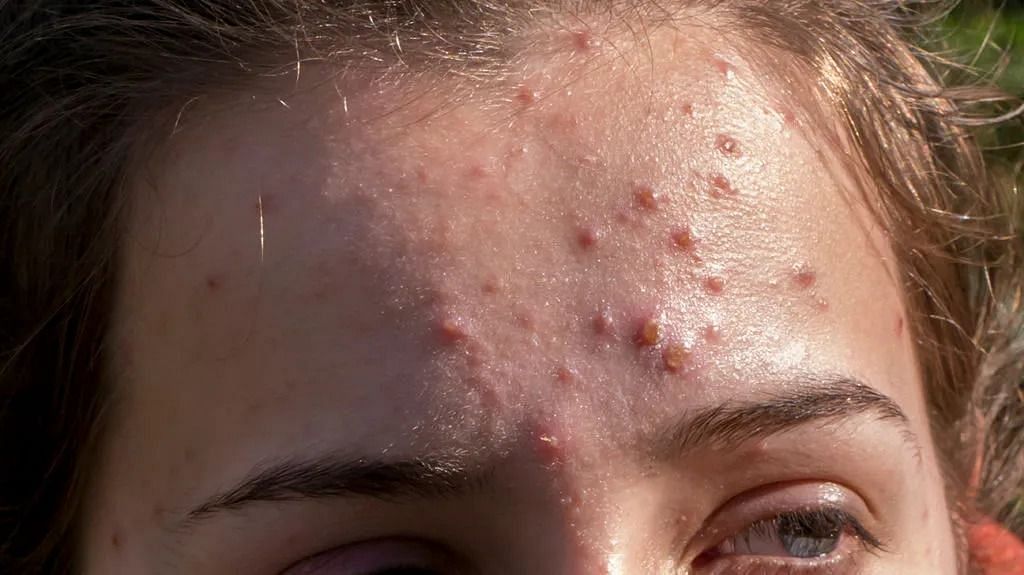 Acne on the forehead (Image via Getty Images)