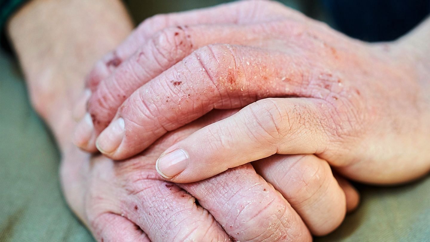 Dyshidrotic-eczema (Image via Getty Images)