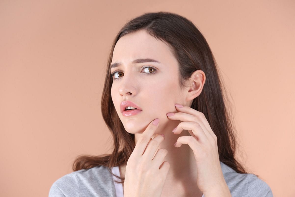 Toothpaste on pimple (Image via Getty Images)