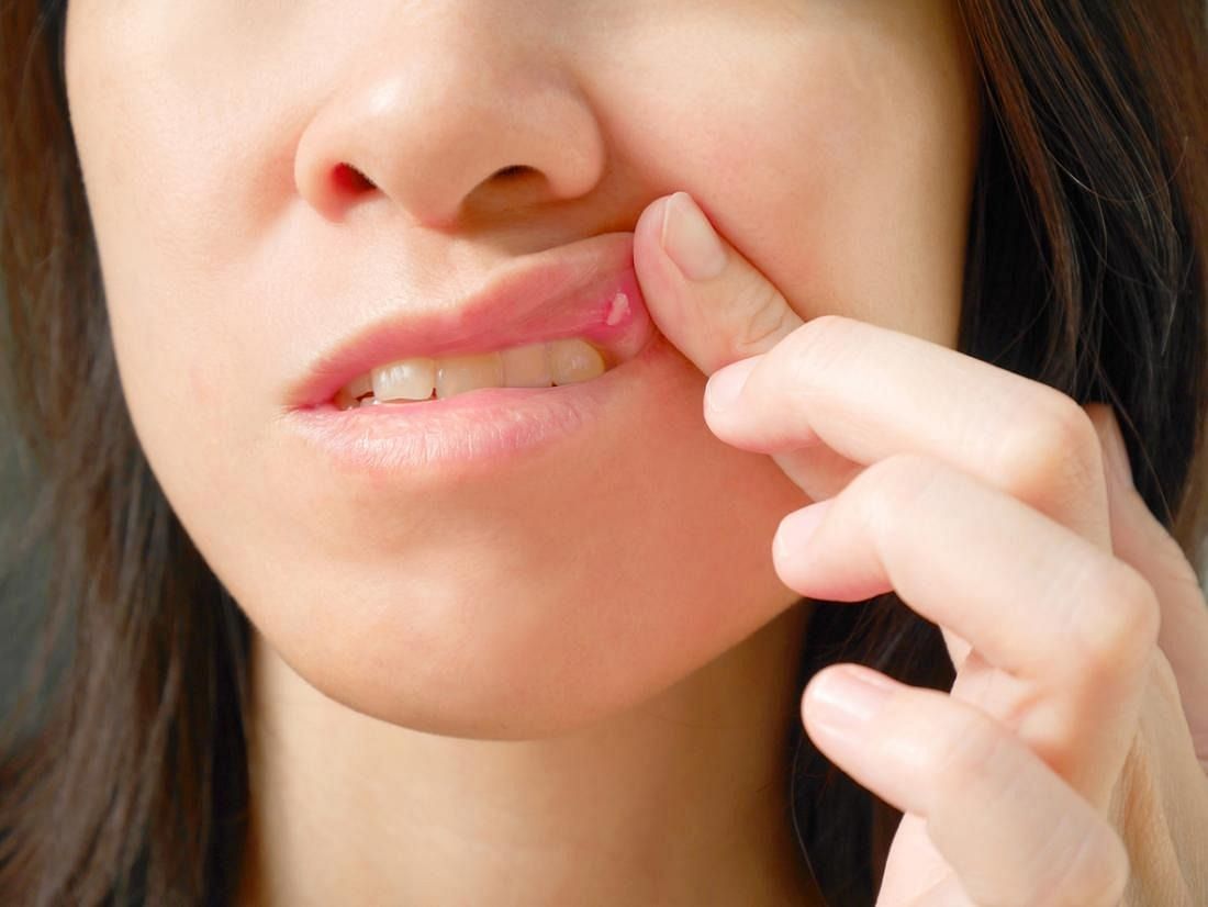 Canker-sores (Image via Getty Images)