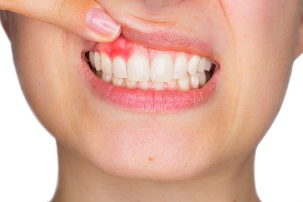 Canker Sores (Image via Getty Images)