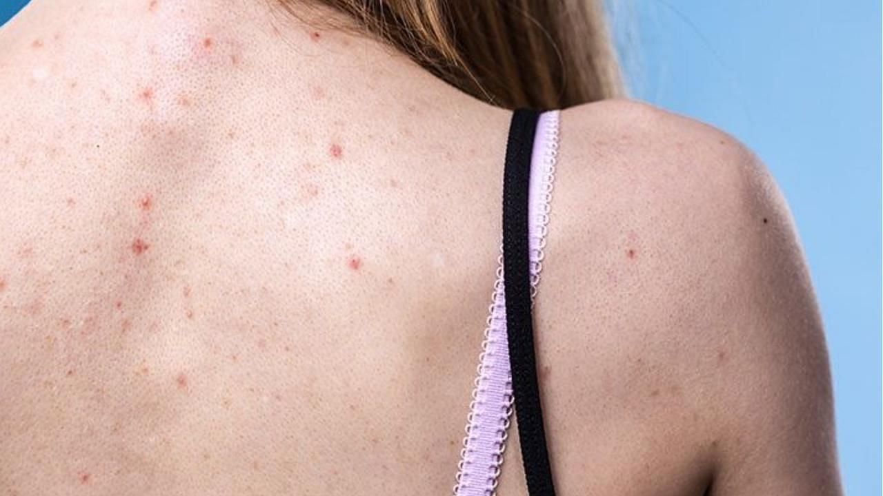 Acne on the back (Image via Getty Images)