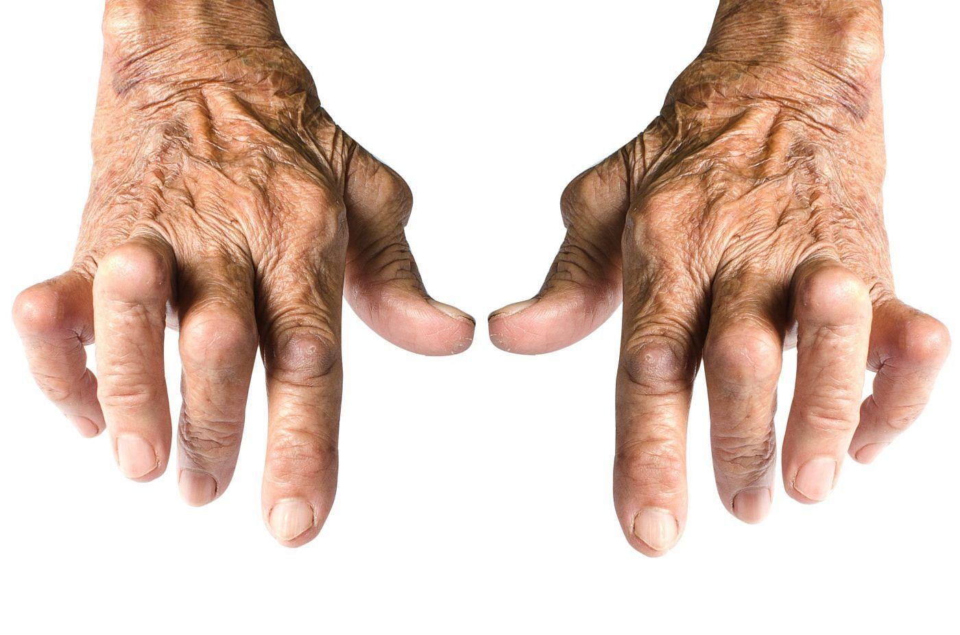 Human hands with the specific condition (Image via getty)