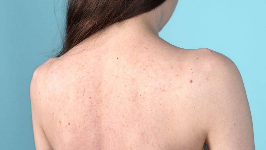 Acne on the back (Image via Getty Images)