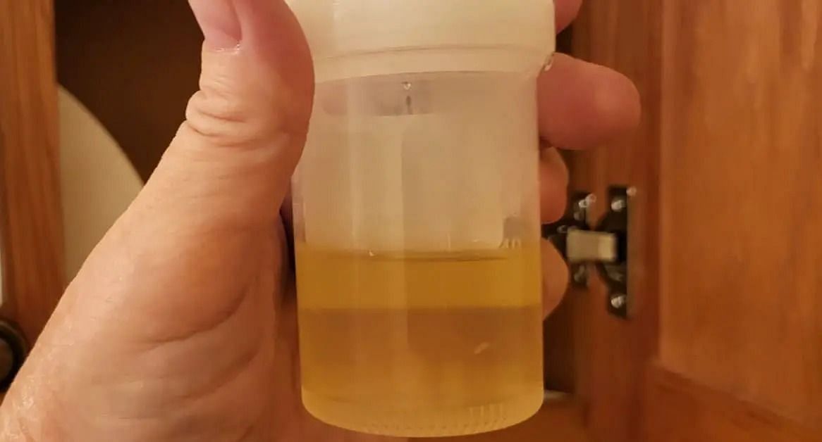 Foamy urine sample (Image via XRF)