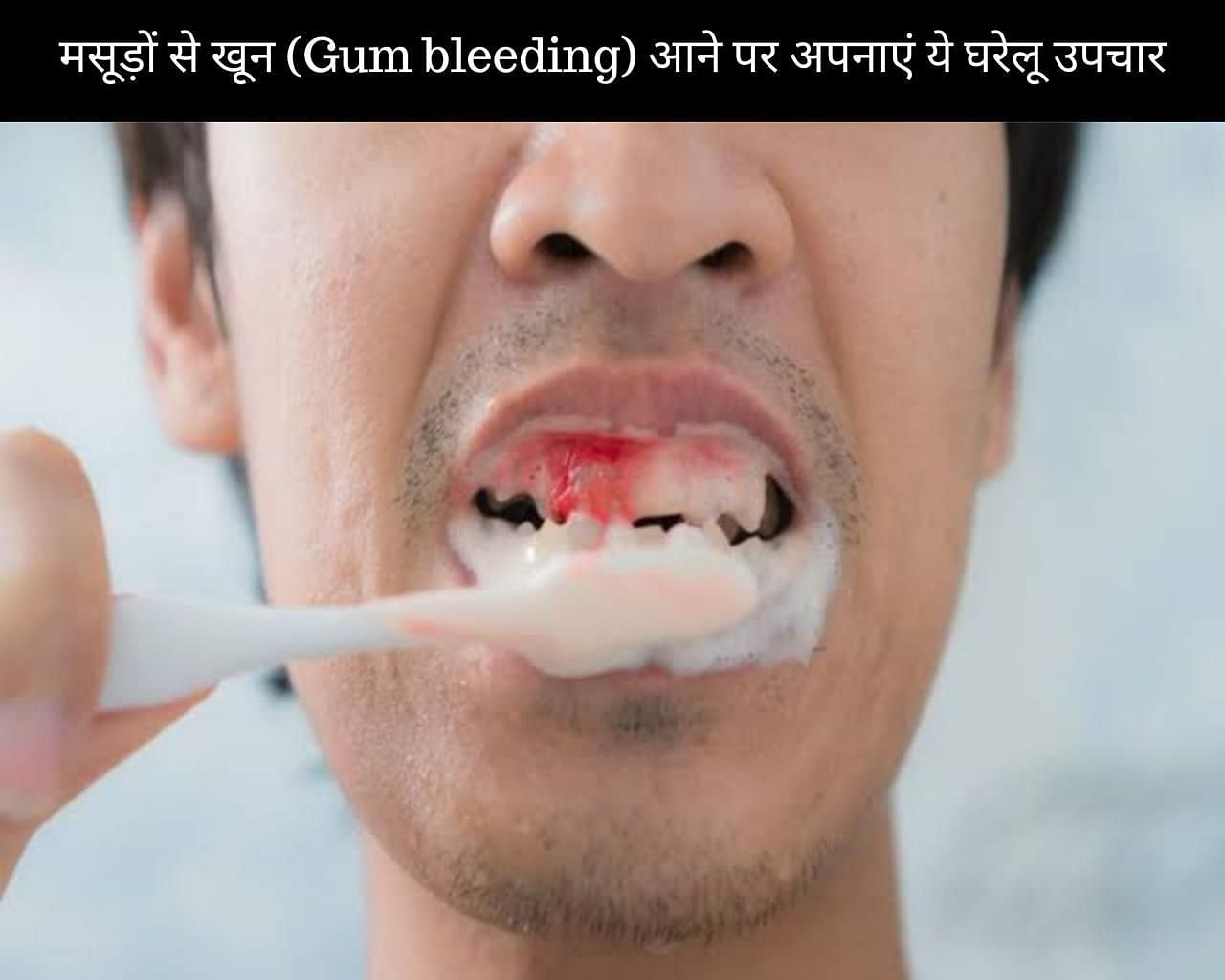 मसूड़ों से खून (Gum bleeding) आने पर अपनाएं ये 9 घरेलू उपचार (फोटो - sportskeedaहिन्दी)