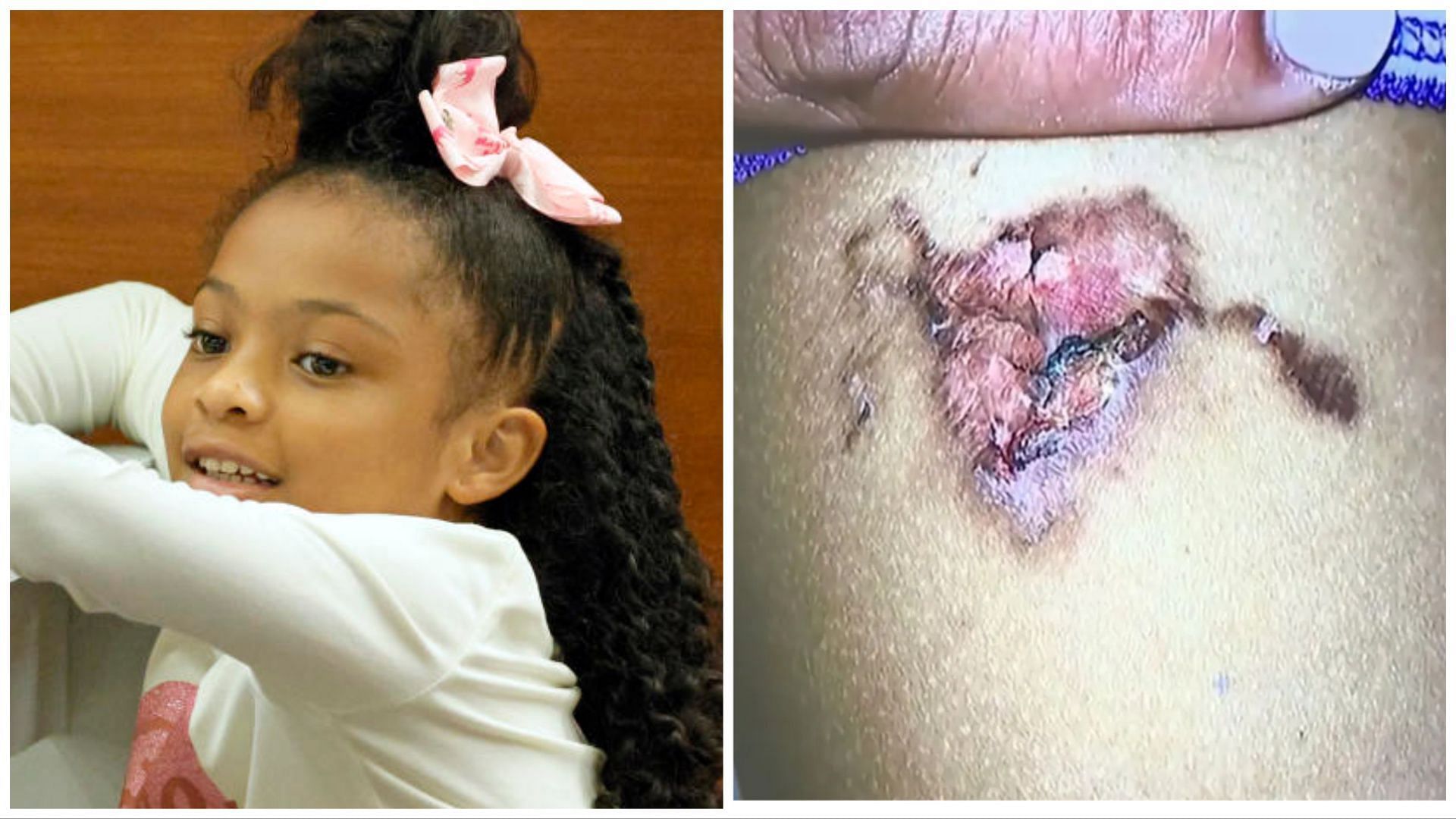 8-year-old Olivia Caraballo received severe burns from a hot McNugget (Image via Associated press)