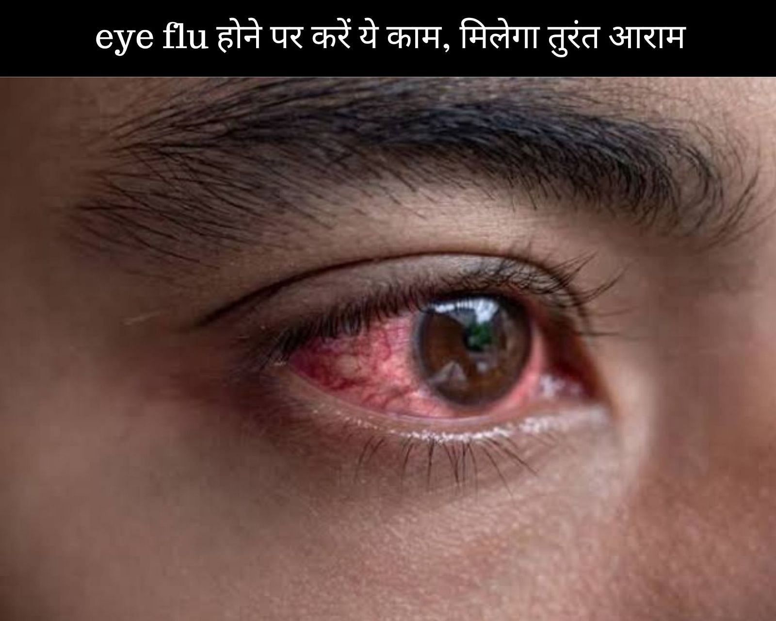 eye flu होने पर करें ये 12 काम, मिलेगा तुरंत आराम (फोटो - sportskeedaहिन्दी)