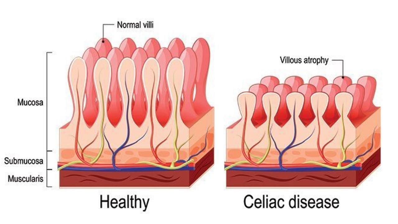 Celiac disease (Image via Getty Images)