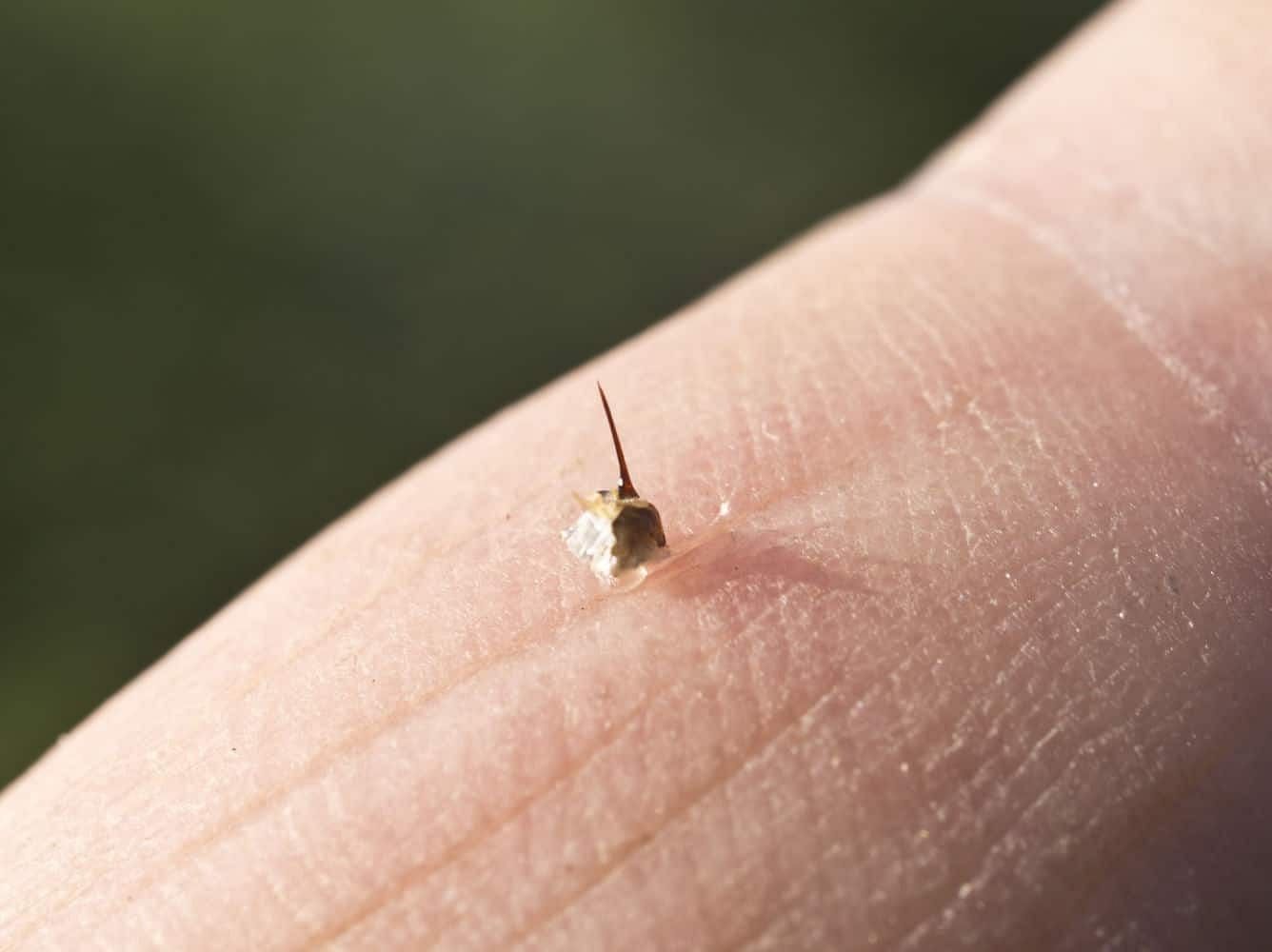 Wasp-sting (Image via Getty Images)