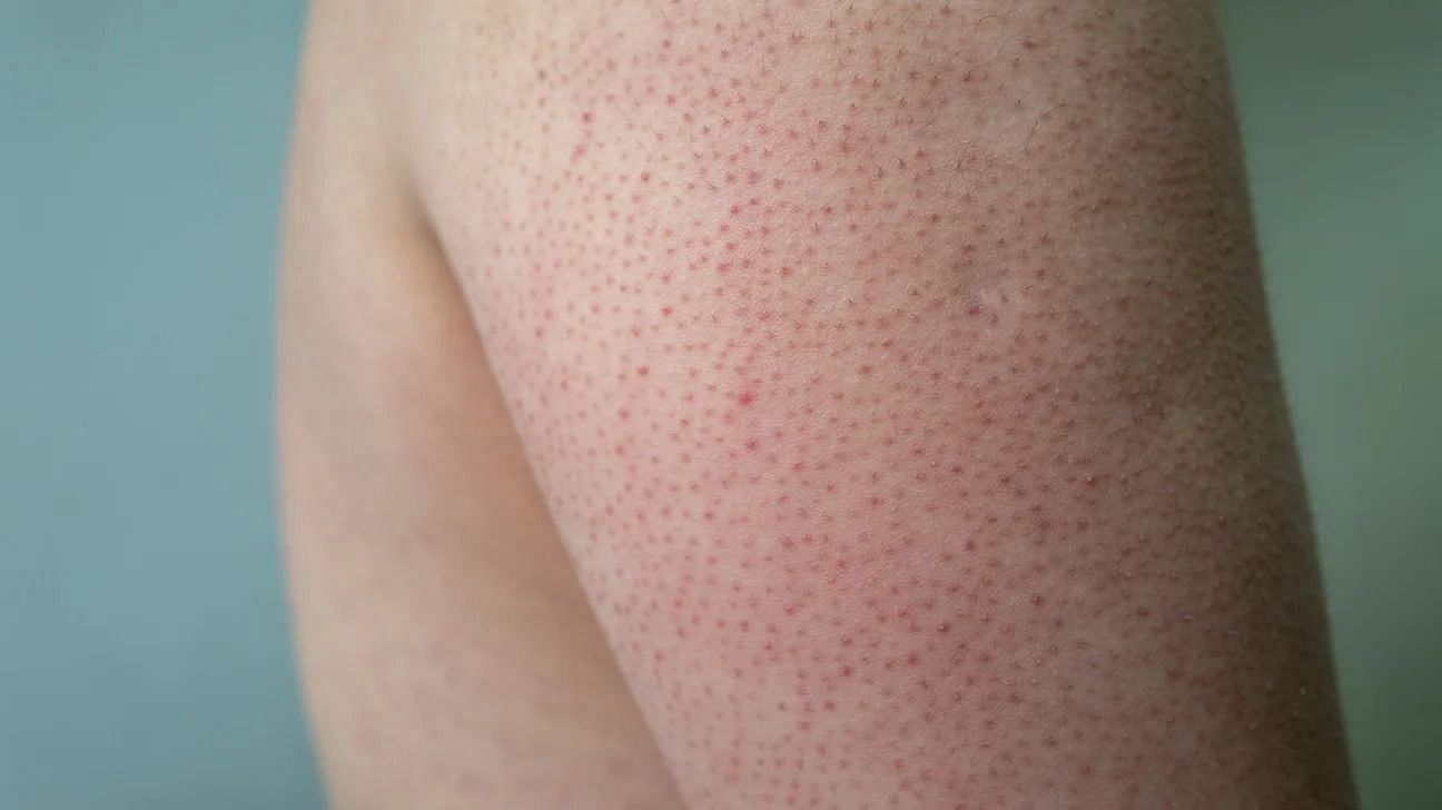 Keratosis pilaris (Image via Getty Images)